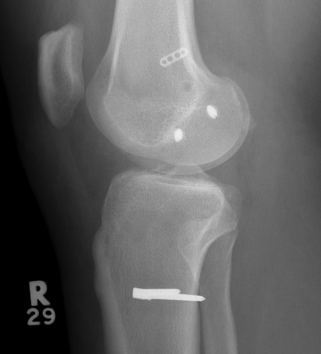 MCL Reconstruction Lateral